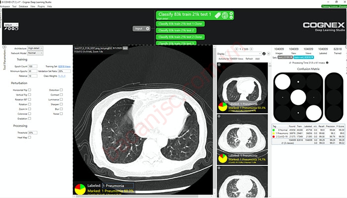 Hình ảnh quét CT của phổi bệnh nhân