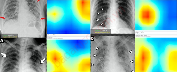 Bản đồ nhiệt hình ảnh phổi đứng